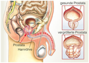 Mehr über den Artikel erfahren Ich begrüße immer meine Freunde mit Prostata kommt von Prost und tata.